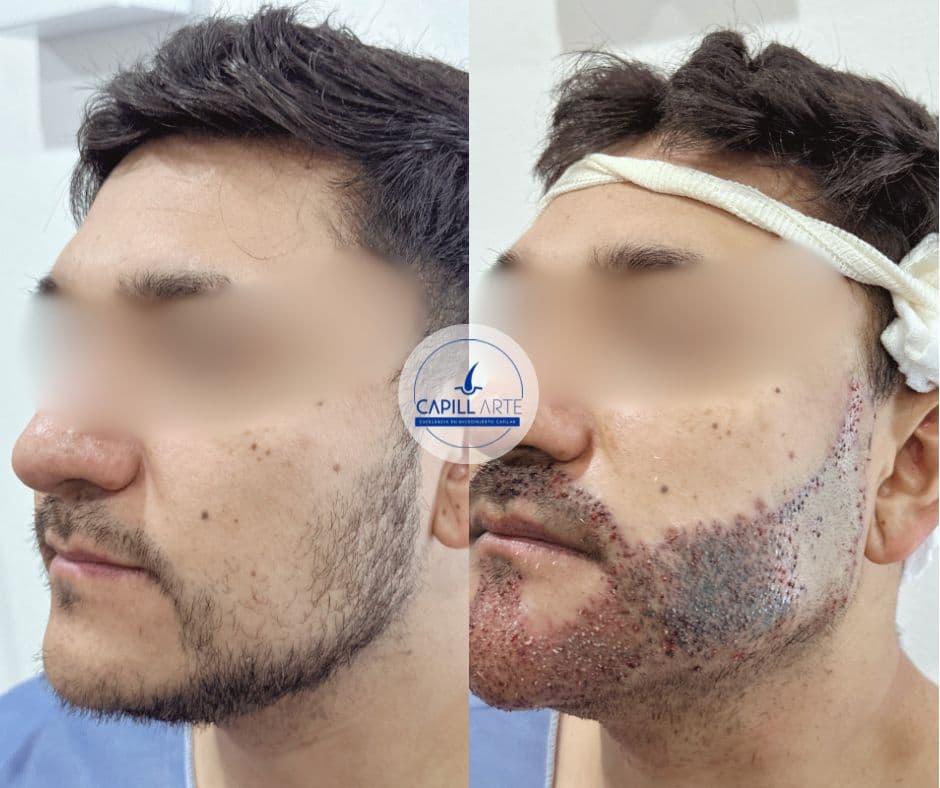 Barba • 6m • Microinjerto de barba