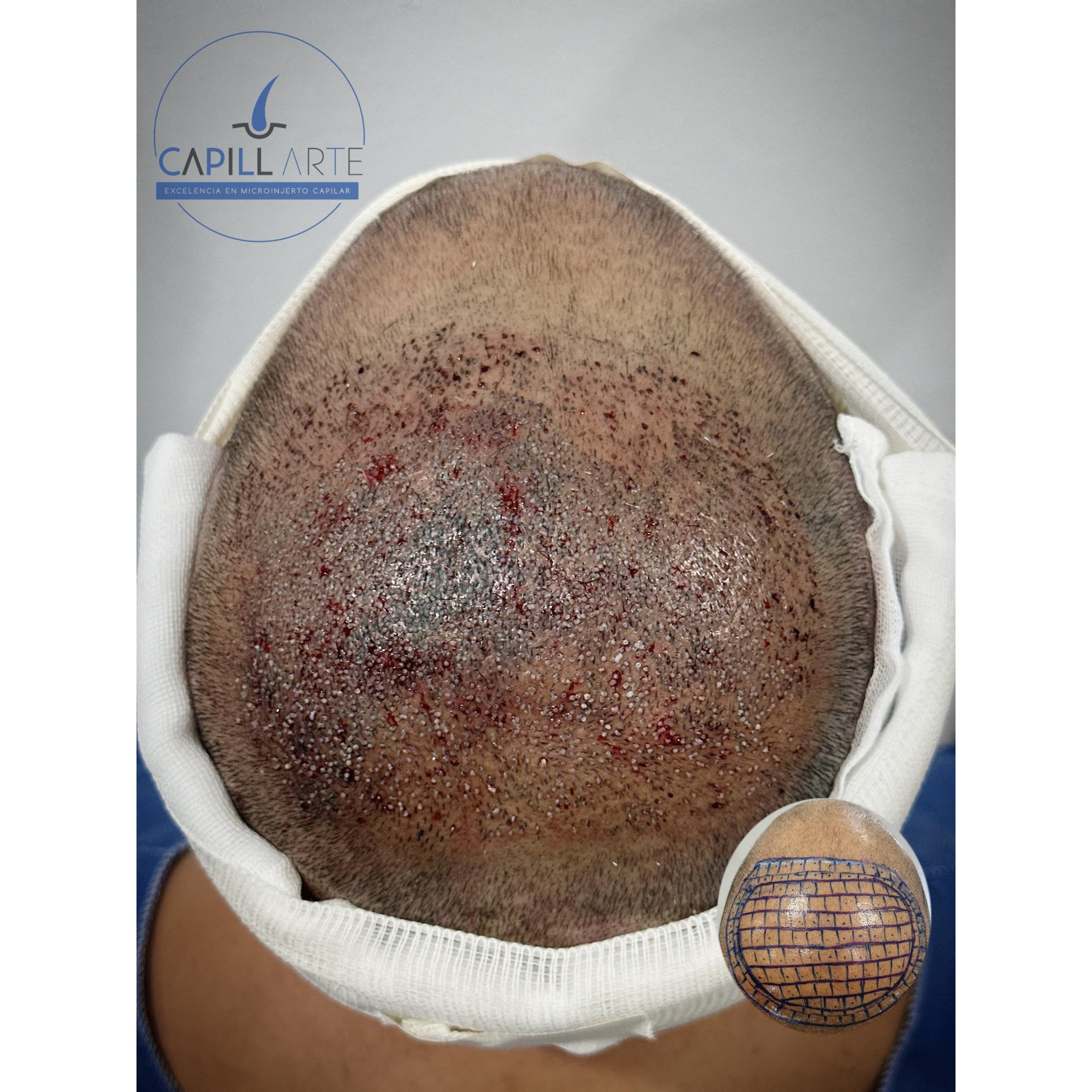 Coronilla • 6m • Microinjerto capilar