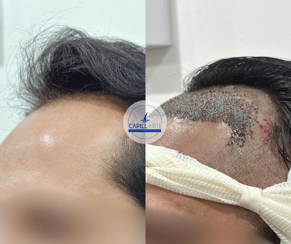 Frontal • 12m • Microinjerto capilar