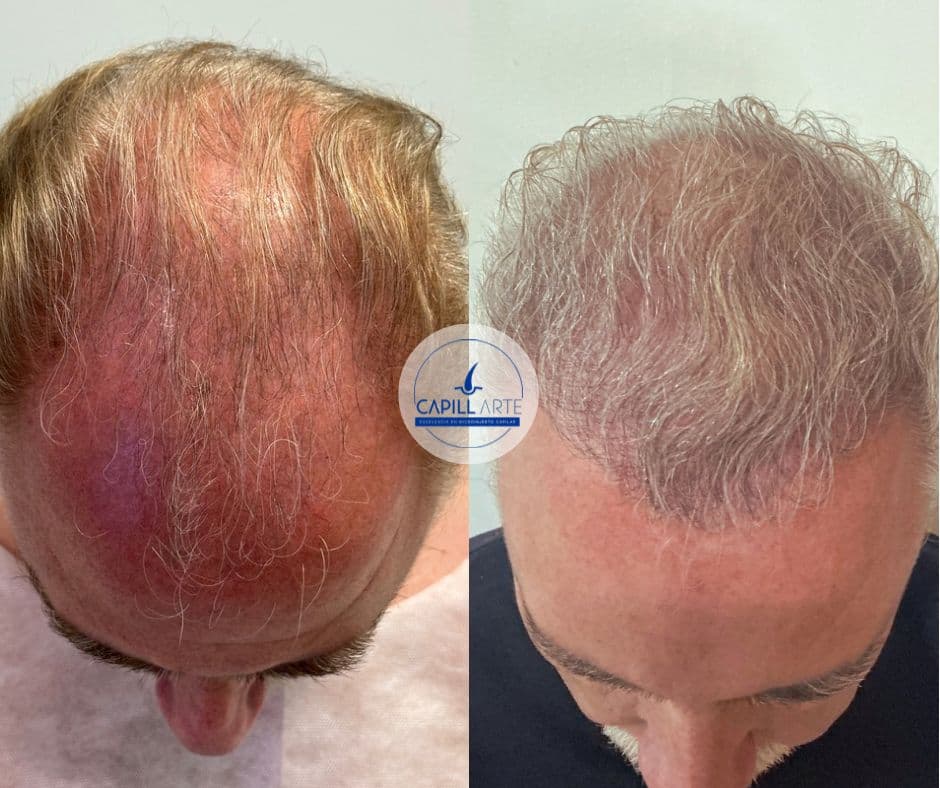 Otros • 12m • Microinjerto capilar